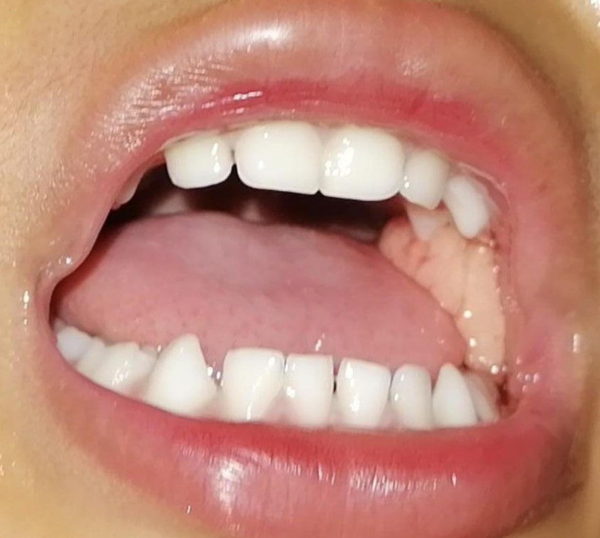 Buccal Fat Pad Herniation, Repositioning Versus Excision A New Algorithm of Treatment